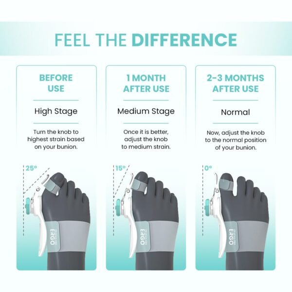 UltraCare PRO Bunion Corrector - Adjustable Toe Alignment with 3D Knob - Image 3