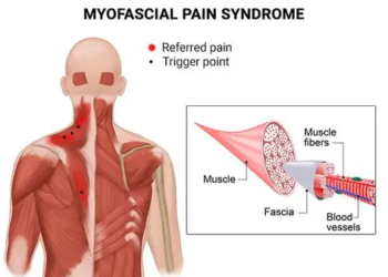 Myofascial Pain Syndrome (MPS)