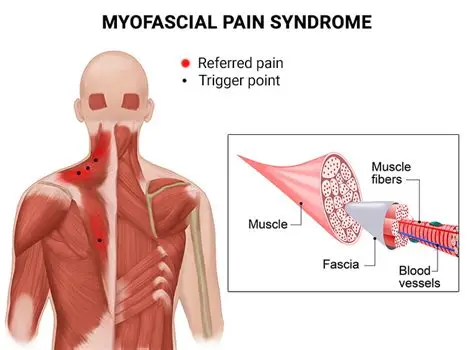 Myofascial Pain Syndrome (MPS)