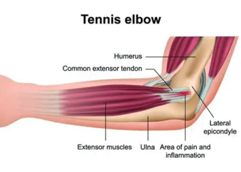 How to Treat Tennis Elbow Naturally – Backed by Experts