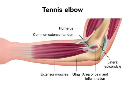 How to Treat Tennis Elbow Naturally – Backed by Experts