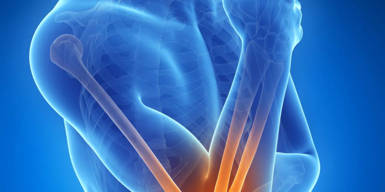 7 Proven Ways to Relieve Tennis Elbow Without Medication