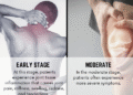 Rheumatoid Arthritis Progression: The 4 Critical Stages You Should Know