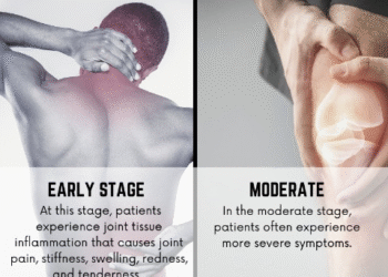 Rheumatoid Arthritis Progression: The 4 Critical Stages You Should Know