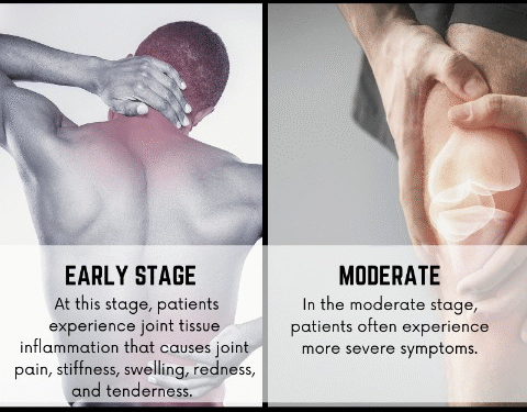Rheumatoid Arthritis Progression: The 4 Critical Stages You Should Know
