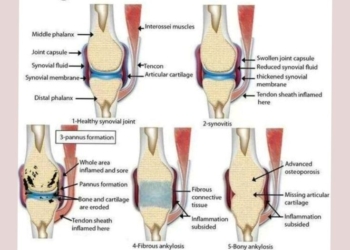 Effective Rheumatoid Arthritis Relief: Best Treatments & Lifestyle Advice