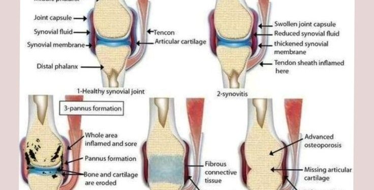 Effective Rheumatoid Arthritis Relief: Best Treatments & Lifestyle Advice