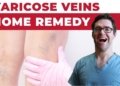 varicose vein care