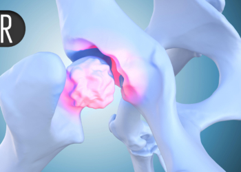 Full-Year Data Back TYK2 Blocker in Psoriatic Arthritis