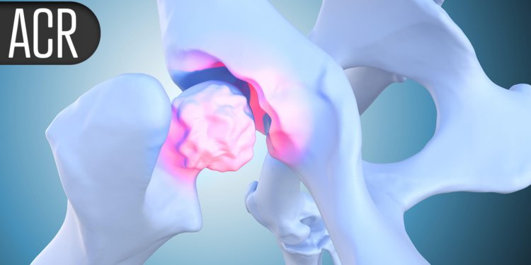 Full-Year Data Back TYK2 Blocker in Psoriatic Arthritis