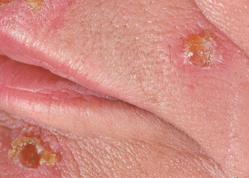 Make the Diagnosis: This Eruption Is Spreading. Is It Related to Her Recent Organ Transplant?