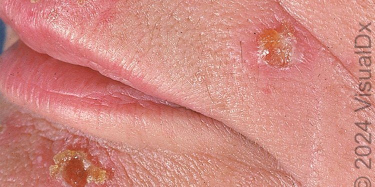 Make the Diagnosis: This Eruption Is Spreading. Is It Related to Her Recent Organ Transplant?