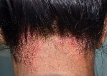 Common Skin Condition Tied to Wide Range of Epithelial Barrier Diseases