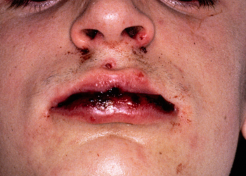 Stevens-Johnson Syndrome Support Lags After Hospital Discharge, Survivors Say