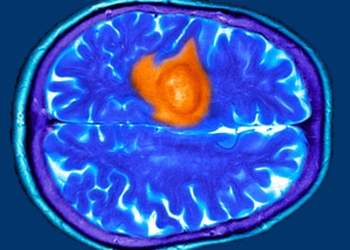 Popular Heart Burn Drugs Linked to Worse Survival in Another Cancer Type