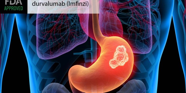 FDA OKs Perioperative Immunotherapy for Stomach Cancer