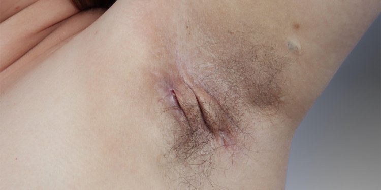 Hidradenitis Suppurativa Progression Not as Common as Previously Believed?