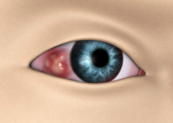 Compounded Imiquimod Shows Promise for Ocular Surface Cancers