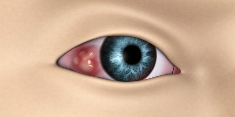 Compounded Imiquimod Shows Promise for Ocular Surface Cancers