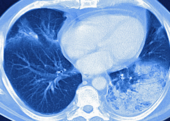 Corticosteroids May Boost Short-Term Survival in Pneumonia, ARDS