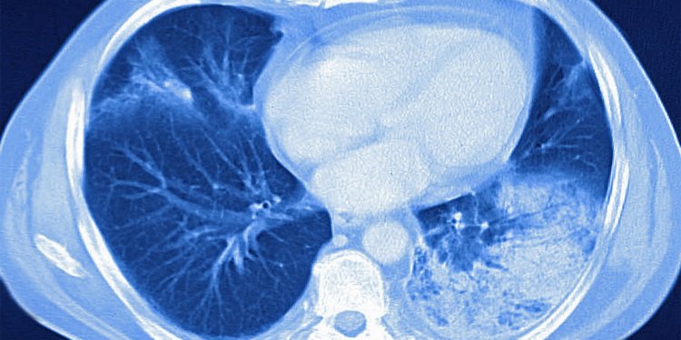Corticosteroids May Boost Short-Term Survival in Pneumonia, ARDS