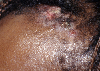 Make the Diagnosis: What Do the Punch Biopsy Findings Suggest?
