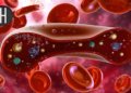 IV Iron Tied to Lower Mortality Risk in Anemics Battling Infection