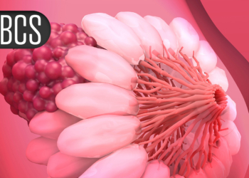 Preop RT May Boost Response to Chemo-Immunotherapy in High-Risk Early Breast Cancer