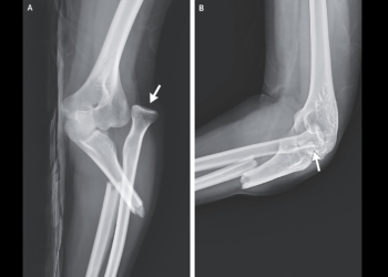 Woman’s Ice-Skating Fall Produces Striking X-Ray, Rare Forearm Break