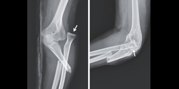 Woman’s Ice-Skating Fall Produces Striking X-Ray, Rare Forearm Break