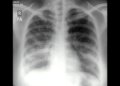 Combination Model May Improve Diagnosis of Serious Respiratory Infections