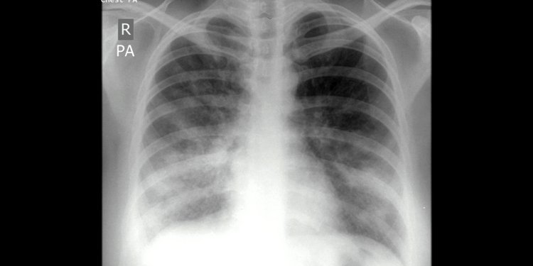 Combination Model May Improve Diagnosis of Serious Respiratory Infections