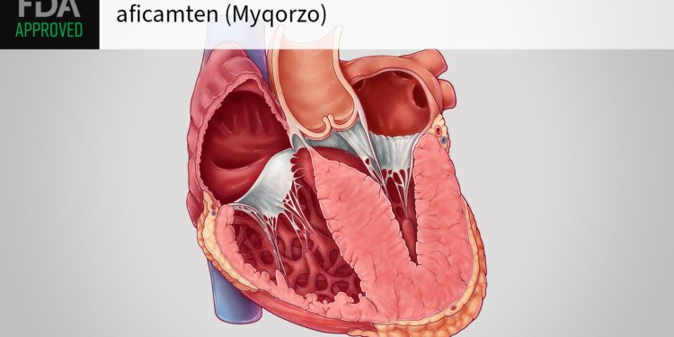 New Drug Approved for Hypertrophic Cardiomyopathy