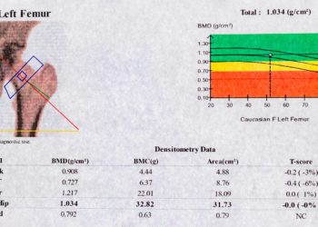 FDA Opens Door to Quicker Approval of Osteoporosis Drugs