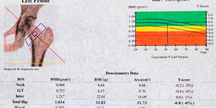 FDA Opens Door to Quicker Approval of Osteoporosis Drugs