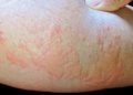 The Promise of Biomarkers to Direct Chronic Spontaneous Urticaria Therapy