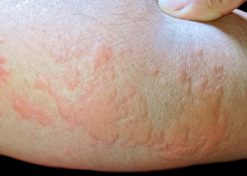 The Promise of Biomarkers to Direct Chronic Spontaneous Urticaria Therapy