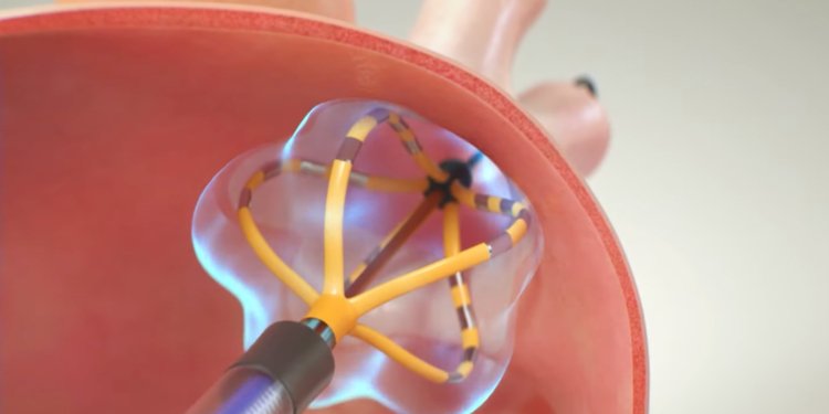 Pulsed Field Ablation Safety Issues: Will Newer Devices Clear the Stumbling Block?