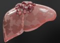 Liver Cancer Treatment Landscape Shifts Rapidly, but Best Sequencing Still Unclear