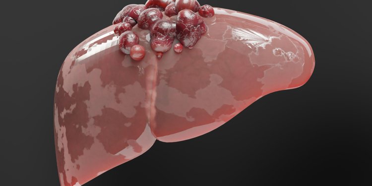 Liver Cancer Treatment Landscape Shifts Rapidly, but Best Sequencing Still Unclear
