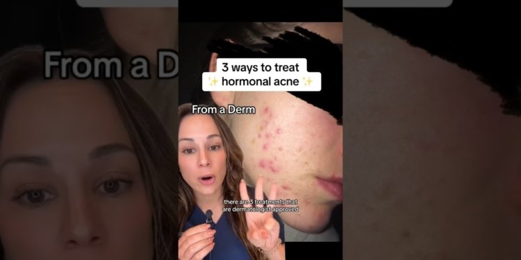 hormonal acne