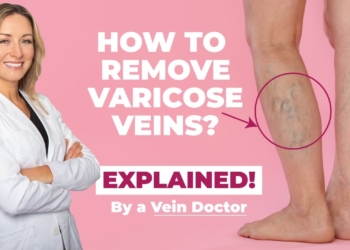 varicose vein care