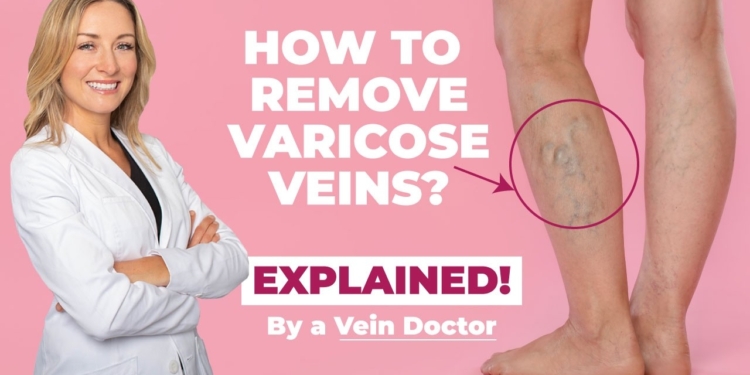 varicose vein care