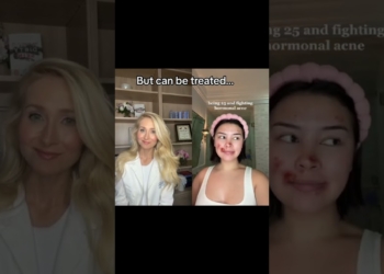 hormonal acne