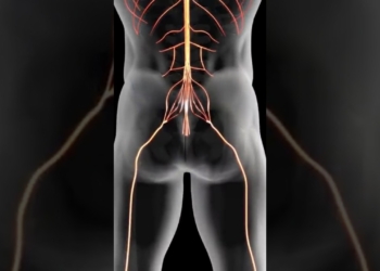sciatica cure