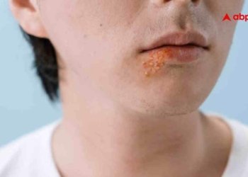 Zoster Infection क्या है? जानें इस वायरल बीमारी की हर एक डिटेल