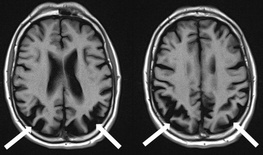 📰 Terry Pratchett and Early-Onset Dementia: Why His Story Still Matters