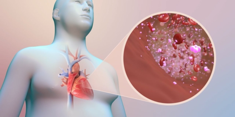 Diabetes and Heart Disease