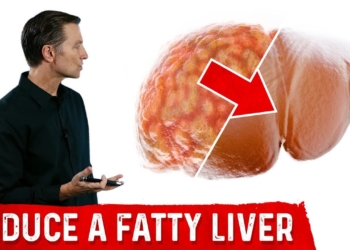 The Best Fatty Liver Exercise – Treatment of Fatty Liver – Dr.Berg