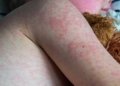 Close up of a child's shoulder showing red spots from measles